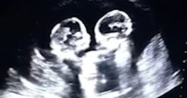 "خناقة فى الرحم".. جولة ملاكمة بين توأم صينى قبل الولادة.. فيديو صور