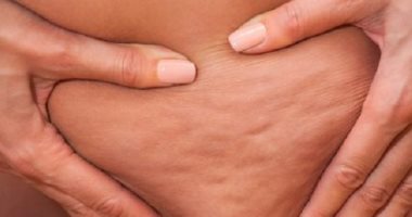 أسباب السلوليت ونصائح لعلاجه