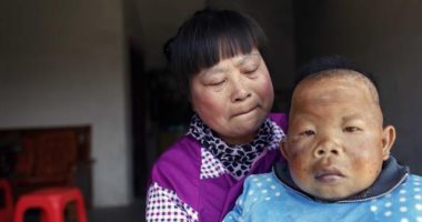 العمر 30 سنة والسن 3.. قصة رجل صينى لم يخرج من مرحلة الطفولة 