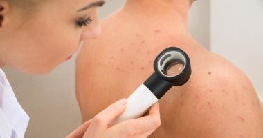 تخلصى من الرؤوس السوداء بطرق طبيعية وكريمات وأقنعة العناية 