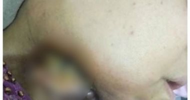 سناء سيدة تعانى من سرطان باللسان وابنتها تطالب بسرعة علاجها