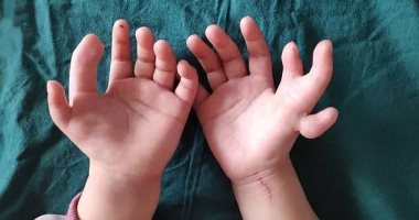 صور.. ولادة فتاة بـ14 إصبعا.. وإجراء عملية لتصحيح العيب الخلقى