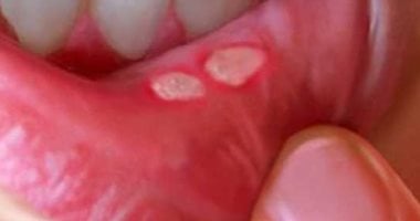 صحتك فى وصفة.. البيكربوناتو والريحان لعلاج قرح الفم