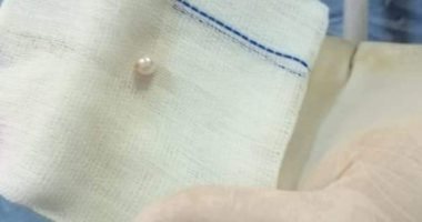 صور.. فريق طبى ببنها الجامعى ينقذ حياة طفل عمره 4 شهور ابتلع خرزة