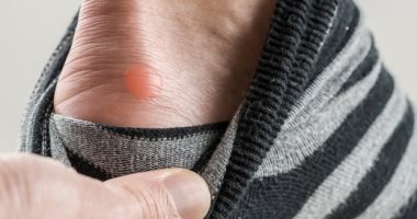 طرق التخلص من بثور الدم بشكل آمن.. غسل اليدين قبل لمسها وتجنب العبث بها