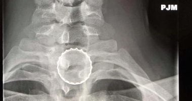 خدها كتذكار من صديقه.. رجل يبتلع غطاء زجاجة دون قصد.. اعرف القصة؟