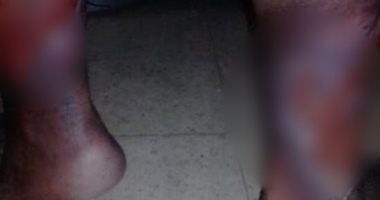 مريض يعانى آلام بالقدم تعوقه عن الحركة يناشد وزارة الصحة التدخل لعلاجه