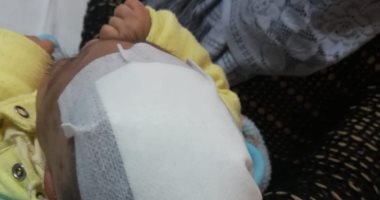 فريق طبى بمستشفى المنصورة ينجح فى استئصال كيس مائى من جمجة طفل
