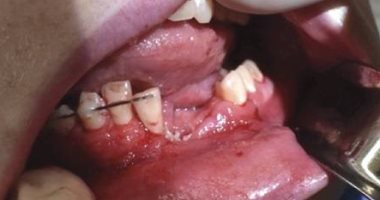 أغرب حكم قضائى.. تعويض سيدة فقدت أسنانها بعد محاولتها الهروب من دفع فاتورة