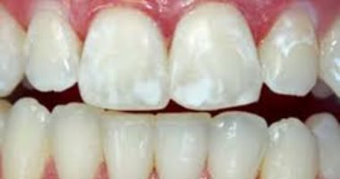بالشاى الأخضر والزيوت الطبيعية.. 3 طرق هتساعدك فى التخلص من بقع الأسنان البيضاء