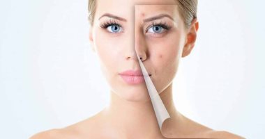 لصاحبات البشرة الدهنية.. 3 مواد طبيعية هتخلصك من مشكلة حب الشباب