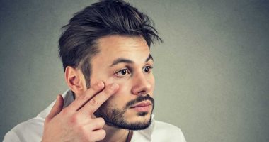 الهالات السوداء مش عند البنات بس.. وصفات طبيعية لعلاجها عند الشباب