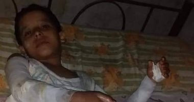 صور.. 6 أطفال مصابين بحروق فى انفجار أنبوبة بالقليوبية يناشدون بمساعدتهم
