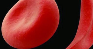 الخلايا المنجلية.. مرض وراثى علاجه الوحيد زرع خلايا جذعية سليمة