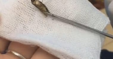 شاهد.. طبيب يسحب نحلة من أذن رجل بعد أن ظلت ثلاثة أيام داخلها