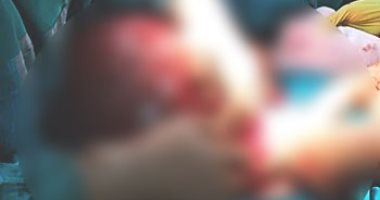 صور.. فريق طبى ينجح فى استئصال ورم سرطانى يزن 25 كيلو من سيدة بأسوان