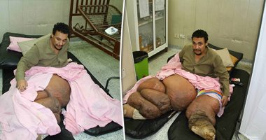 وزنه 400 كجم ولم يتحرك من السرير منذ 5 سنوات.. محمود أصيب بداء الفيل ولا يستطيع الحركة.. قرح الفراش وتضخم ساقيه يمنعان الحركة..محافظة القاهرة نقلته للمستشفى باستخدام ونش..المريض: أناشد المسئولين توفير علاج وسكن
