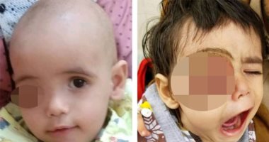 شاهد.. الطفل اليمنى "رواف" بعد تكفل ولى العهد السعودى بعلاجه