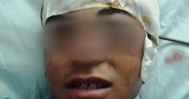 أطباء مستشفى سوهاج الجامعى ينجحون فى استخراج "مفك" بطول 30 سم اخترق مخ طفل