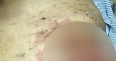 الإهمال الطبى واستخدام أدوات غير معقمة يتسبب فى تدهور حالة مسنة