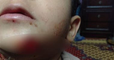 الكلاب الضالة تهاجم طفلا وتحدث به إصابات بالغة بمدينة السلام