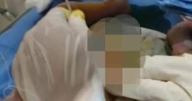 صور.. توفير خدمة الغسيل الكلوى البروتونى للأطفال بمستشفى السنبلاوين العام