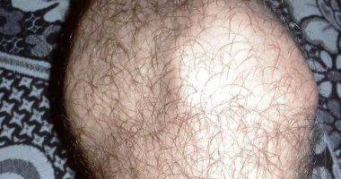 معاق ومش معاق بورق حكومى.. شاب يشكو من استخراج تقرير طبى مخالف لحالته