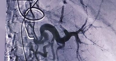 صور.. نجاح أول حالة قسطرة علاجية لحقن وغلق شرايين الطحال النشط بجامعة سوهاج