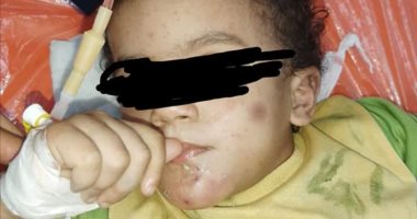 بعد الطفلة "هبة" في دمياط..  ضحية جديدة لزوجة الأب في القليوبية