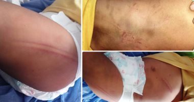جريمة عائلية فى القليوبية.. إصابة الطفلة رحاب بكسر 4 ضلوع وكدمات بسبب اعتداءات زوجة الأب.. والدها يتهم زوجته الثانية: مفترية وكررت الواقعة مع ابنى.. وتقرير مستشفى بنها: إصابات الطفلة تدل على تعذيبها لعدة أيام