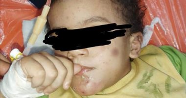 تقرير مستشفى بنها الجامعى يكشف تفاصيل جريمة تعذيب طفلة على أيدى زوجة أبيها