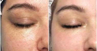 فى الصيف جلسات الـ " BB Glow " تعالج جميع مشاكل البشرة