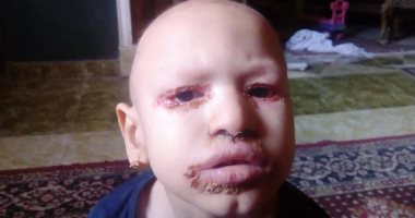 صور.. مأساة طفلة بالغربية تعانى من مرض غير معروف يسبب لها تشوهات
