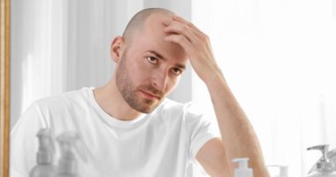 سبب الصلع مش شرط يكون وراثى.. اعرف السر