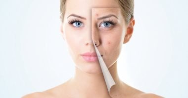 بخطوات سهلة وبسيطة..طرق للتخلص من حب الشباب
