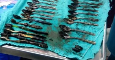 صور.. فريق جراحى بالمنصورة يستخرج ملاعق وشوك وخواتم من أمعاء مريض