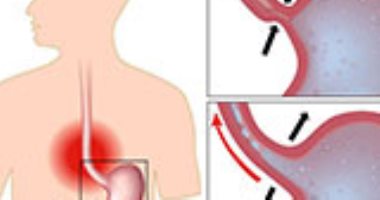 تعرف ايه عن داء الجزر؟.. أعراضه تشبه حموضة المعدة.. تشمل ألما فى الصدر والمعدة.. التدخين والسمنة أسباب أساسية للإصابة بالمرض.. وأبرز مضاعفاته سرطان المرىء.. والعلاج يتضمن الأدوية والالتزام بنظام غذائى صحى