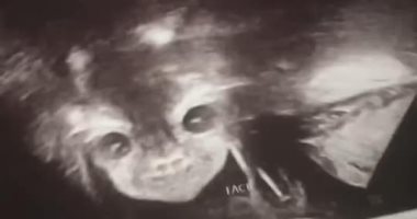 صور.. اعرف حكاية "جنين شيطانى" أثار ضجة على مواقع التواصل الإجتماعى