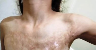 مأساة الطفلة رحمة بالشرقية تعرضت للحرق ووالدتها تناشد أهل الخير لمساعدتها