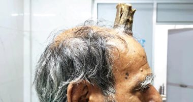 للمرة الثانية.. رجل هندى ينمو له "قرن" فى رأسه بطول 10 سم
