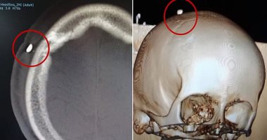 صبي يعض زميله فى مباراه كرة قدم ويترك له ذكرى فى جمجمته..اعرف الحكاية
