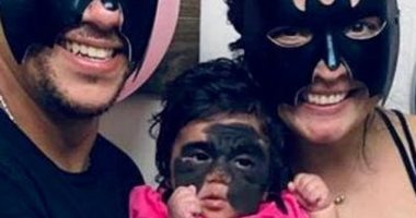 براءة وجه طفلة يختفي خلف قناع "باتمان" وشفاءها يحتاج لـ 100 عملية جراحية 