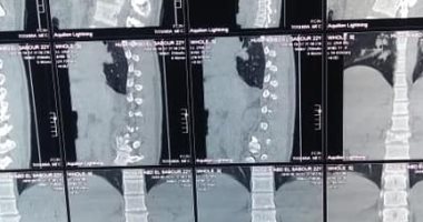 صور.. مستشفى أرمنت التخصصى تجرى جراحة لأول مرة بالصعيد لشاب مصاب بكسر بالفقرات