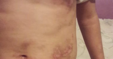 شقيقة جنة: جدتى حرقتنى فى أماكن حساسة.. والطب الشرعى: "غشاء البكارة سليم"