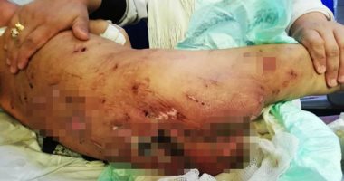 صور.. "جنة وأمانى" ضحيتا تعذيب جدتهما بالحرق والكى وخلع الأظافر