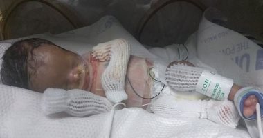 أطباء ينجحون فى إنقاذ طفل ولد دون جلد.. وأمه تحتضنه لأول مرة.. صور