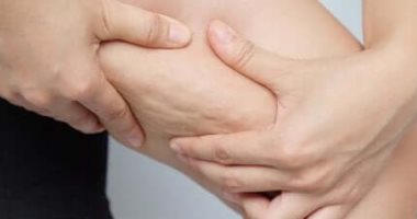 4 أنظمة غذائية تساعدك فى التخلص من السليوليت.. أهمها الأناناس والباذنجان