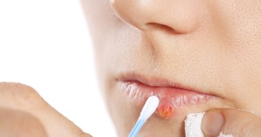 نصائح تساعد فى علاج قرح الفم منها الأدوية المضادة للفيروسات