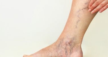 كيف تحمى نفسك من تمدد الأوعية الدموية والجلطات؟.. بالأكل الصحى والرياضة