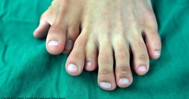 صور.. صينى لديه تسعة أصابع بقدمه اليسرى يخضع لجراحة أخيرا بعد رفض والديه